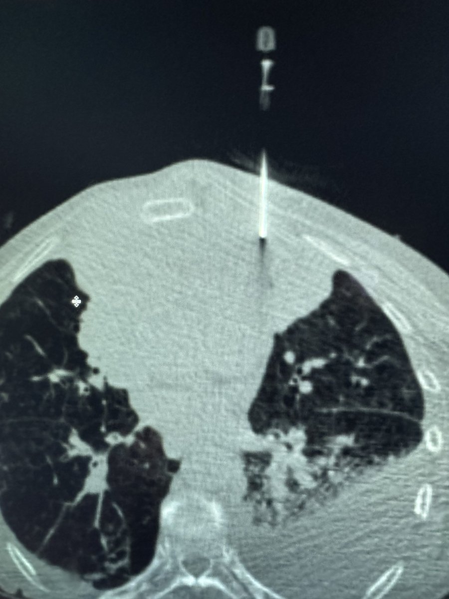 Joe Mammarappallil (@jmammarappallil) on Twitter photo 🚨#radres fellows: Another awesome procedure day <a href="/DukeRadiology/">Duke Radiology</a> <a href="/DukeRadCTI/">DukeCTI</a> . 5! Case day. Rib lesion x2, difficult basilar nodule, Chest tube, Anterior mediastinal mass. Full service fellowship learning from the BEST of the BEST! <a href="/MikeHarowiczMD/">Mike Harowicz</a> <a href="/JRadMD/">Jared Christensen MD, MBA</a> <a href="/osullivanmurphy/">Bryan O’Sullivan-Murphy</a> 🚨#radres fellows: Another awesome procedure day <a href="/DukeRadiology/">Duke Radiology</a> <a href="/DukeRadCTI/">DukeCTI</a> . 5! Case day. Rib lesion x2, difficult basilar nodule, Chest tube, Anterior mediastinal mass. Full service fellowship learning from the BEST of the BEST! <a href="/MikeHarowiczMD/">Mike Harowicz</a> <a href="/JRadMD/">Jared Christensen MD, MBA</a> <a href="/osullivanmurphy/">Bryan O’Sullivan-Murphy</a>