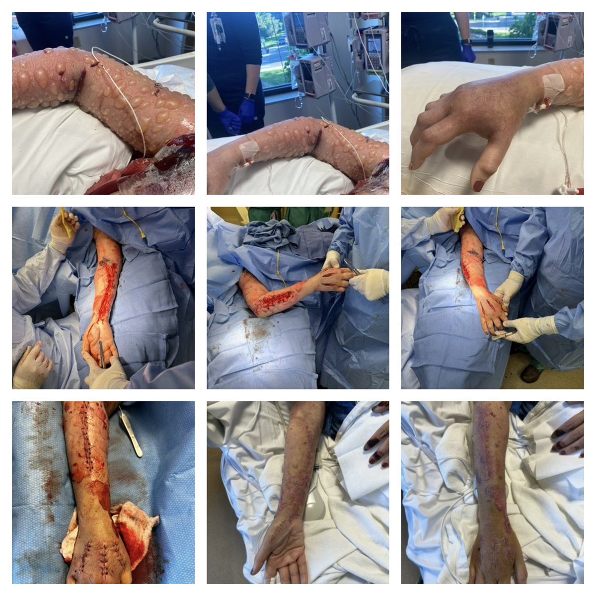 Mile High Vascular, A Value Added Network (@5280vascular) on Twitter photo Sometimes the hand surgeons aren’t around and we as vascular surgeons need to provide #comprehensivevascularcare for limb salvage! Arm and hand are fully functional! #limbsalvage #faciotomiessave #medtwitter <a href="/VascularSVS/">Society for Vascular Surgery</a> <a href="/FutureVascSurgn/">FutureVascSurgeons</a> Sometimes the hand surgeons aren’t around and we as vascular surgeons need to provide #comprehensivevascularcare for limb salvage! Arm and hand are fully functional! #limbsalvage #faciotomiessave #medtwitter <a href="/VascularSVS/">Society for Vascular Surgery</a> <a href="/FutureVascSurgn/">FutureVascSurgeons</a>