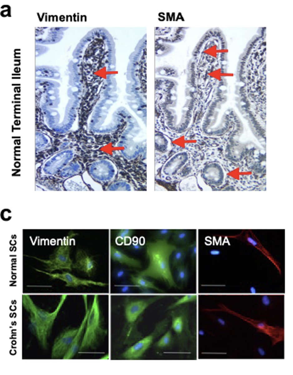 Human stromal cells can promote healthy mucosa, however they may produce reduced retinoic acid during #Crohns disease contributing to inflammation: mucosalimmunology.org/article/S1933-…