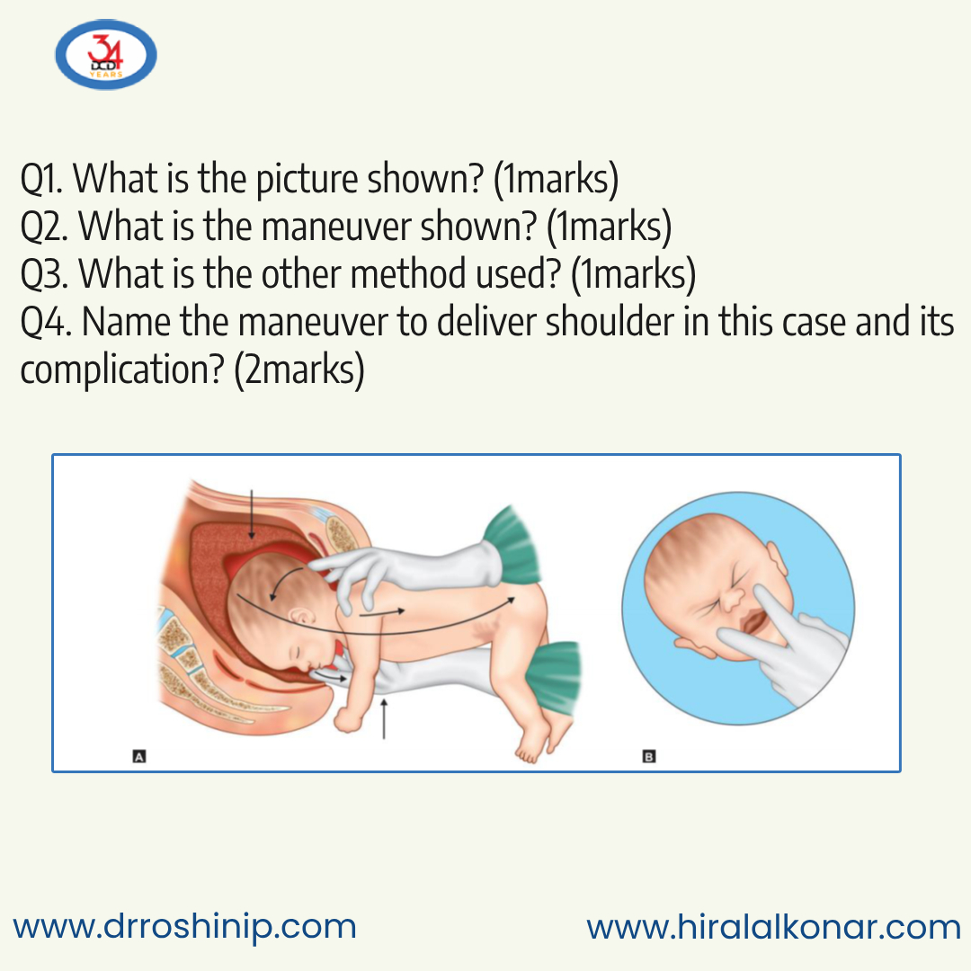 DCDuttaBooks's tweet photo. Q1. What is the picture shown? (1marks)
Q2. What is the maneuver shown? (1marks)
Q3. What is the other method used? (1marks)
Q4. Name the maneuver to deliver shoulder in this case and its complication? (2marks)

Follow us to learn more.

Reference:
https://t.co/RxcI42ejYY https://t.co/98jEhIlujL