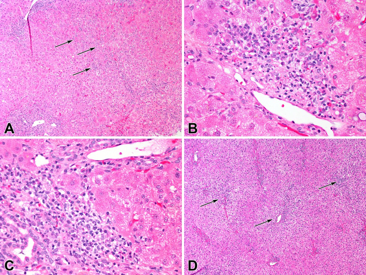 Robert Fontana (@robertfontanamd) on Twitter photo COVID Vaccines & DILI? 16 cases of mRNA Vaccines acute hep at 16 d. 75% hepatocellular, 37% jaundice; 88% resolve by mon 6; steroids in 37%. ↑ERAP-1/ERAP-2 variants. <a href="/MichiganLiver/">Michigan Hepatology</a> <a href="/lilydara/">Bruce Sanderson</a> PMID: 38314748 DOI: 10.14309/ajg.0000000000002702 COVID Vaccines & DILI? 16 cases of mRNA Vaccines acute hep at 16 d. 75% hepatocellular, 37% jaundice; 88% resolve by mon 6; steroids in 37%. ↑ERAP-1/ERAP-2 variants. <a href="/MichiganLiver/">Michigan Hepatology</a> <a href="/lilydara/">Bruce Sanderson</a> PMID: 38314748 DOI: 10.14309/ajg.0000000000002702