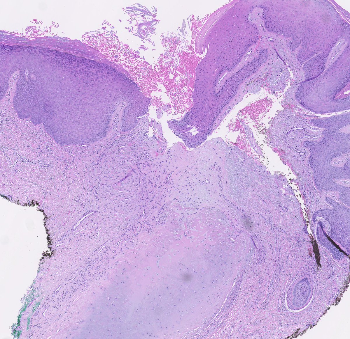 Chondrodermatitis nodularis helicis! You don't always see the "textbook" cartilage alterations. #dermpath