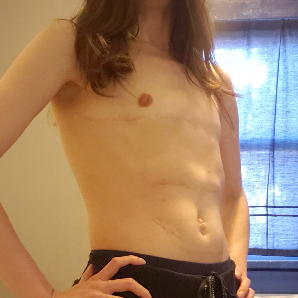 Trans_Ash1's tweet photo. A year and 3 months post top surgery! 🎉🏳️‍⚧️🏳️‍🌈 https://t.co/r763KCOfX6