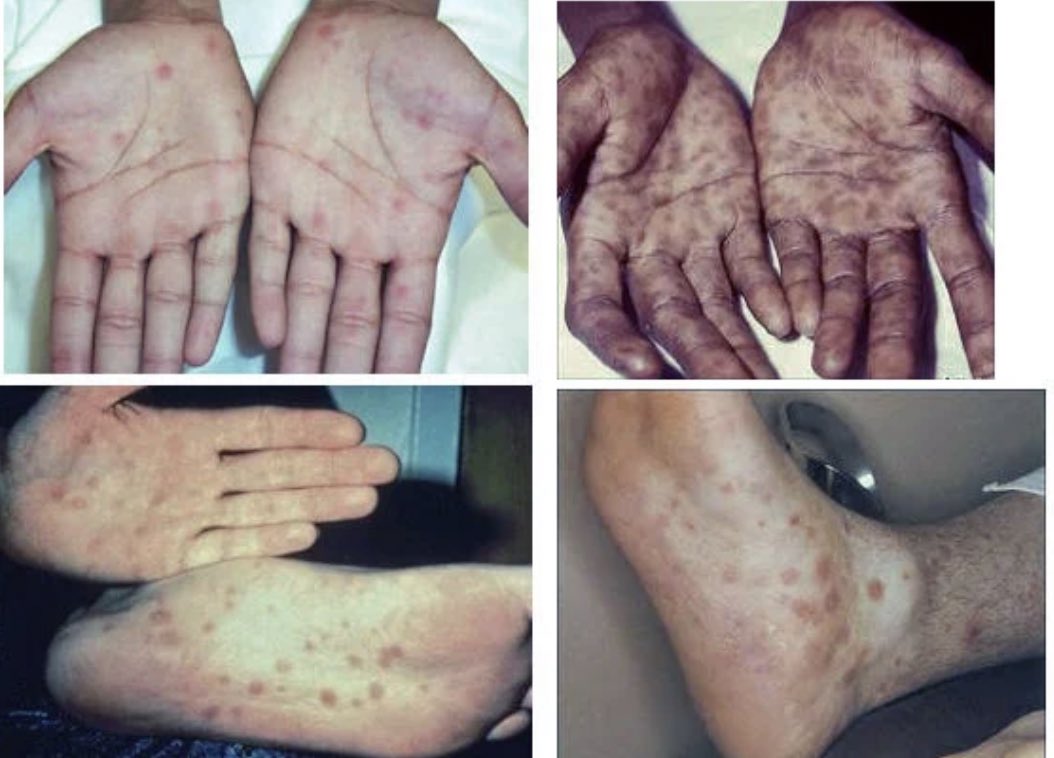 This is the second stage of syphilis.

Syphilis is one of the most undetectable sexually transmitted infections.

It is also the deadliest.

What are the stages of syphilis?
How do you identify them on time?