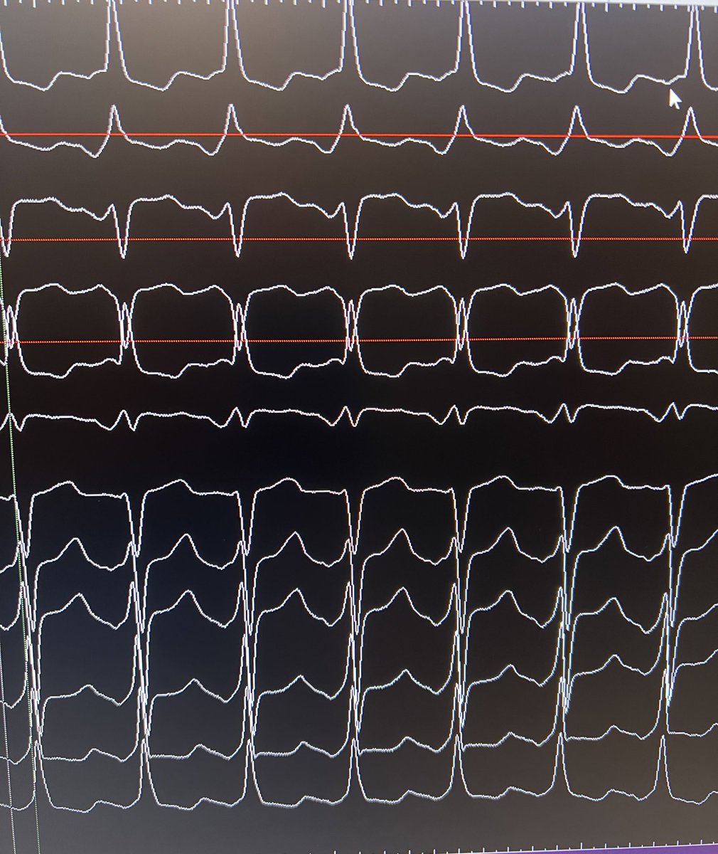 Dominik Linz (@dominik_linz) on Twitter photo #EPeeps
Where to find the origin of this #ATach?
🧐
<a href="/Farnir_Florent/">Farnir Florent</a>
<a href="/PrashSanders/">Prash Sanders</a> <a href="/peterkistler3/">peterkistler MBBS PhD FHRS</a>
<a href="/ChristianHeeger/">Christian-H. Heeger</a> <a href="/Mel_Gunawardene/">Melanie Gunawardene</a> <a href="/dr_pmueller/">Patrick Mueller, MD</a> <a href="/Phiso_de/">Philipp Sommer</a> <a href="/ShaojieChen1/">Shaojie Chen</a> <a href="/kvernooy/">Kevin Vernooy</a> <a href="/Kadhimad/">Kadhim Kadhim</a> #EPeeps
Where to find the origin of this #ATach?
🧐
<a href="/Farnir_Florent/">Farnir Florent</a>
<a href="/PrashSanders/">Prash Sanders</a> <a href="/peterkistler3/">peterkistler MBBS PhD FHRS</a>
<a href="/ChristianHeeger/">Christian-H. Heeger</a> <a href="/Mel_Gunawardene/">Melanie Gunawardene</a> <a href="/dr_pmueller/">Patrick Mueller, MD</a> <a href="/Phiso_de/">Philipp Sommer</a> <a href="/ShaojieChen1/">Shaojie Chen</a> <a href="/kvernooy/">Kevin Vernooy</a> <a href="/Kadhimad/">Kadhim Kadhim</a>