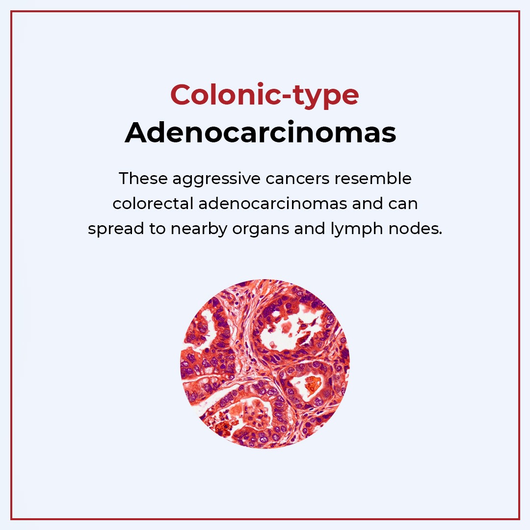 HocVedanta's tweet image. Appendix cancers can come in various forms - each with its own treatment path. Recognising these types can make all the difference in your health journey. #AppendixCancerAwarenessMonth
.
.
.
.
#hocvedanta #hoccancerhospital #hoc #cancercare #cancersupport #healthtips