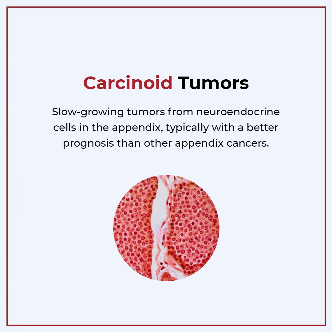 HocVedanta's tweet image. Appendix cancers can come in various forms - each with its own treatment path. Recognising these types can make all the difference in your health journey. #AppendixCancerAwarenessMonth
.
.
.
.
#hocvedanta #hoccancerhospital #hoc #cancercare #cancersupport #healthtips