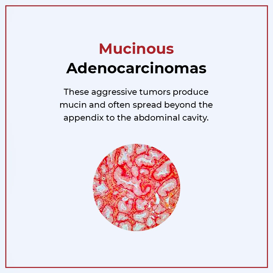 HocVedanta's tweet image. Appendix cancers can come in various forms - each with its own treatment path. Recognising these types can make all the difference in your health journey. #AppendixCancerAwarenessMonth
.
.
.
.
#hocvedanta #hoccancerhospital #hoc #cancercare #cancersupport #healthtips