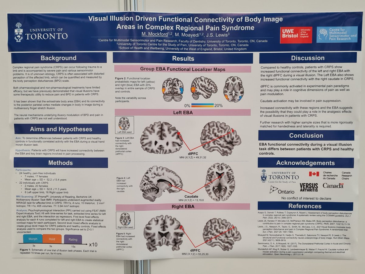 Brain imaging #Body perception disturbance &amp; visual illusions in #CRPS 🧠 visit poster #582 great collaborative work with @massihmoayedi <a href="/mattmockford/">Matt M</a> #WC2024  <a href="/CRPS_SIG/">CRPS SIG</a> <a href="/CRPSUK/">CRPS UK</a> <a href="/CHCR_UWE/">UWE Health Research</a>