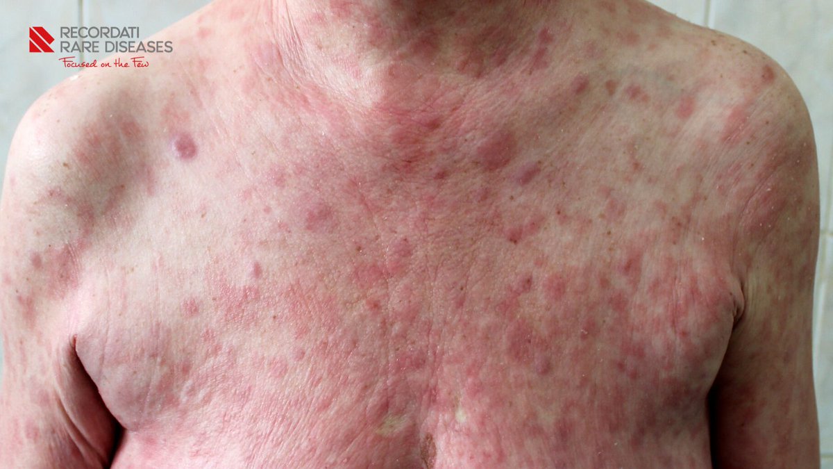 RecordatiRareES's tweet photo. La #MicosisFungoide se confunde con otras patologías como la #psoriasis o la #dermatitisatópica, lo que provoca retrasos en su diagnóstico

🗣️ "El diagnóstico suele tardar una media de 3 años y requiere seis biopsias" @drpabloortiz

https://t.co/S8GdgBHgNU vía @larazon_es https://t.co/8raUgaMbAE