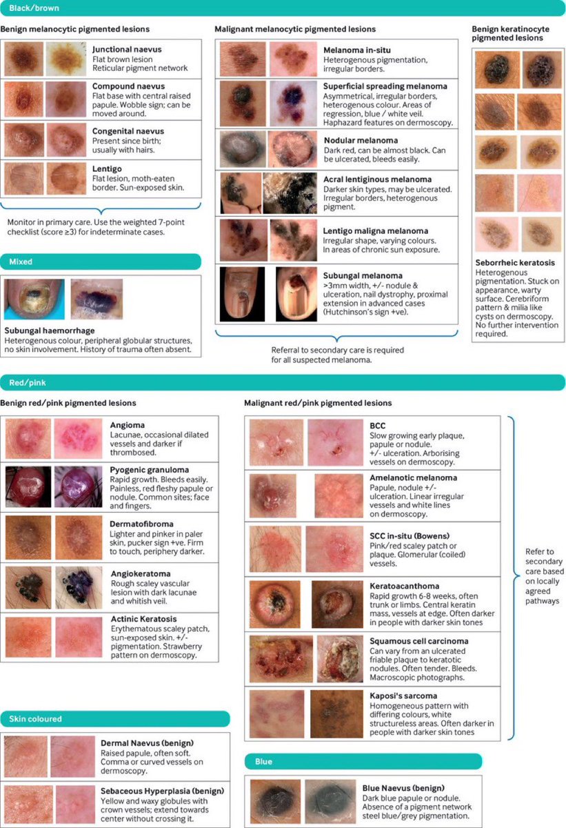 imedverse's tweet photo. How should clinicians assess a pigmented lesion? And what tips are there on how to differentiate benign from malignant skin lesions?
@bmj_latest #Oncology #Meded #medx #Science #Melanoma #pigmented #diagnosis #guidelines
Reference:
https://t.co/Qjf70g0e5x https://t.co/HIazIMKDx7