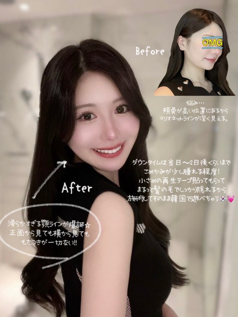 xxasu_'s tweet photo. 🇰🇷で受けたほうれい線(ﾏﾘｵﾈｯﾄﾗｲﾝ)撲滅施術が我ながらに大満足すぎる、、！こんな短期間ですり減ったように頬のたるみってなくなるもんなのか。 https://t.co/MfjBNyPsWC