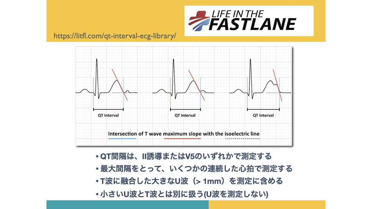 NaokiThukishima's tweet photo. #EPサマーセミナー2024覚え書き-009   
#cLQTS-02

QTcの正確な測定は、用手法が(心電計くんの自動測定)より正確である。自動測定は、長めになる。
必ずV5(or II誘導)で測定すべし!!・・とありました。

でもね、同じ心電図を複数名の医師・検査技師にブラインドで測定させて、その結果を比較すると、けっこう誤差が出たりします💦
検者間格差を無くす努力も必要だと思う🧐