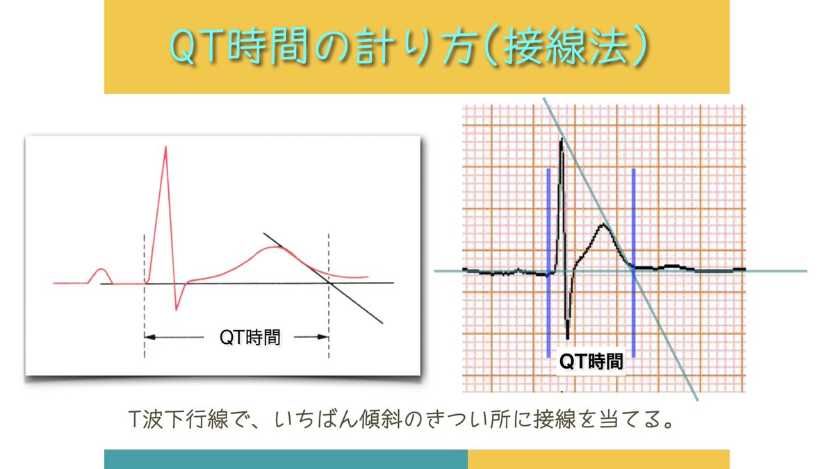 NaokiThukishima's tweet photo. #EPサマーセミナー2024覚え書き-009   
#cLQTS-02

QTcの正確な測定は、用手法が(心電計くんの自動測定)より正確である。自動測定は、長めになる。
必ずV5(or II誘導)で測定すべし!!・・とありました。

でもね、同じ心電図を複数名の医師・検査技師にブラインドで測定させて、その結果を比較すると、けっこう誤差が出たりします💦
検者間格差を無くす努力も必要だと思う🧐