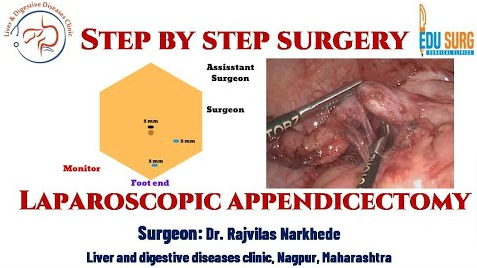 edusurg_clinics's tweet photo. Laparoscopic appendicectomy - step by step surgery - Edusurg clinics. click here to watch full video: https://t.co/8NZxDlRAtb

#Surgery  #LaparoscopicSurgery #LaparoscopicAppendicectomy #Appendectomy #SurgicalEducation #SurgicalSkills  #MedEd    #EdusurgClinics #LearnWithEduSurg https://t.co/4kfpRTGX5r