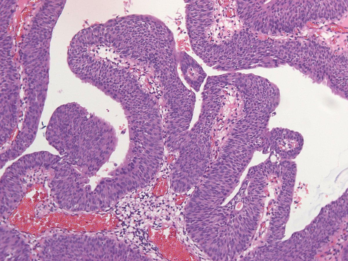 23 year old male with a bladder mass. 
A papillary neoplasm with cytologically bland looking cells exhibitting minimal atypia and maintained cell polarity.
PUNLMP #PathX #PathTwitter #Uropath #Papillarylesionsofbladder