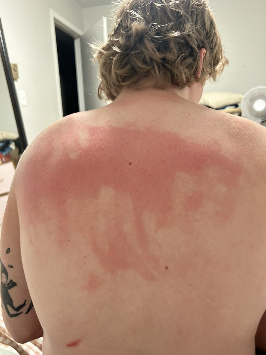 livelaffliam's tweet photo. applied my own sunscreen yesterday. it seems i may have missed a spot https://t.co/m5jaLGhiDn