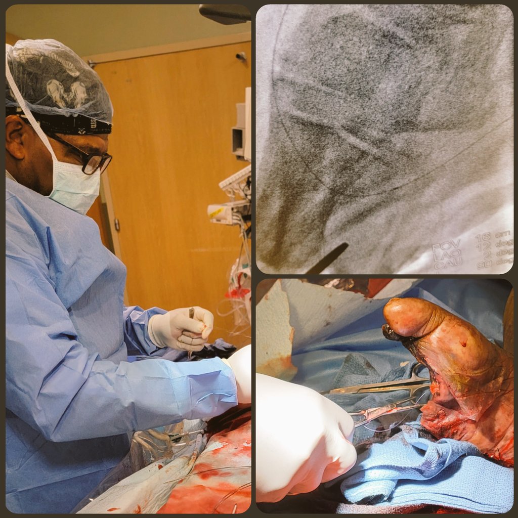 Keith Pereira MD, #VIrad (@keithppereira) on Twitter photo When the podiatrist is summoned to the angio suite to address profuse bleeding during a #DVA, it indicates a promising start...
Never a dull moment!
#VIrad <a href="/SIRspecialists/">Society of Interventional Radiology</a> When the podiatrist is summoned to the angio suite to address profuse bleeding during a #DVA, it indicates a promising start...
Never a dull moment!
#VIrad <a href="/SIRspecialists/">Society of Interventional Radiology</a>