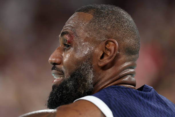 NBALAKERSBLOG's tweet photo. Así le quedó el párpado a LeBron en el golpe que lo sacó del partido, esperemos que por precaución. https://t.co/0vyd0MdBzH