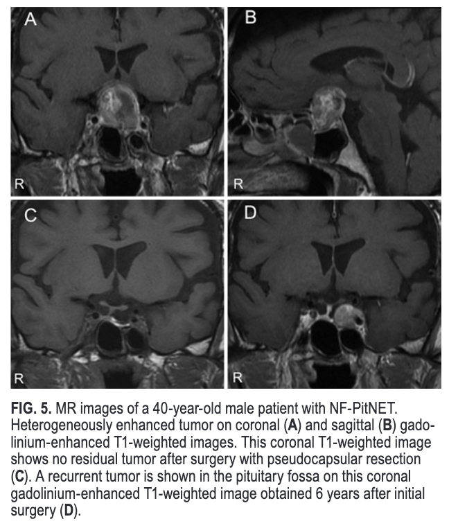 #OnlineFirst: Pseudocapsular resection to prevent recurrence in nonfunctioning pituitary neuroendocrine tumors: a retrospective, single-center study with more than 5 years of follow-up.

thejns.org/view/journals/….