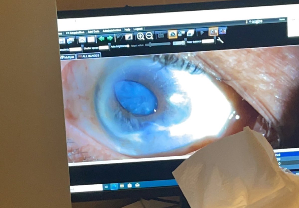 بسألكم 
عين أمي فيها مويه بيضاء والقزحيه متأكله ؟ 
ودكتور قالها أنه اذا سويتها ممكن يجيك مضاعفات بالله مين مثل عين أمي وسواها ماجاه شي بالله طمنوني