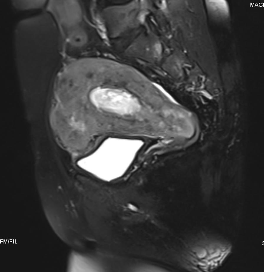 hemo_shk's tweet image. - 58-year-old female with vaginal bleeding for the past 2 months 

- findings and diagnosis ?

#MEDHM @IhabFathiSulima #MedEd 
 #MedX