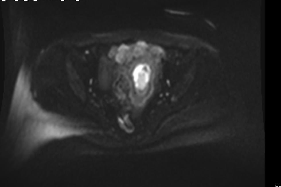 hemo_shk's tweet image. - 58-year-old female with vaginal bleeding for the past 2 months 

- findings and diagnosis ?

#MEDHM @IhabFathiSulima #MedEd 
 #MedX