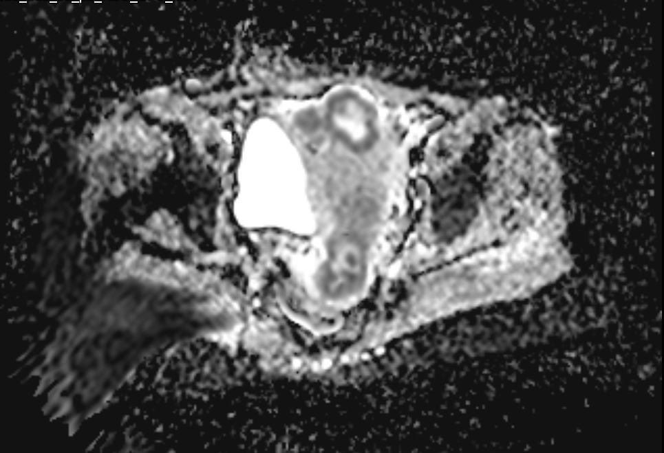 hemo_shk's tweet image. - 58-year-old female with vaginal bleeding for the past 2 months 

- findings and diagnosis ?

#MEDHM @IhabFathiSulima #MedEd 
 #MedX
