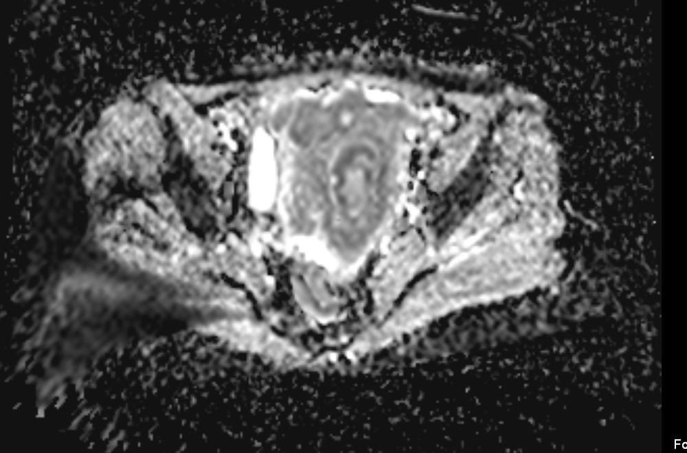 hemo_shk's tweet image. - 58-year-old female with vaginal bleeding for the past 2 months 

- findings and diagnosis ?

#MEDHM @IhabFathiSulima #MedEd 
 #MedX