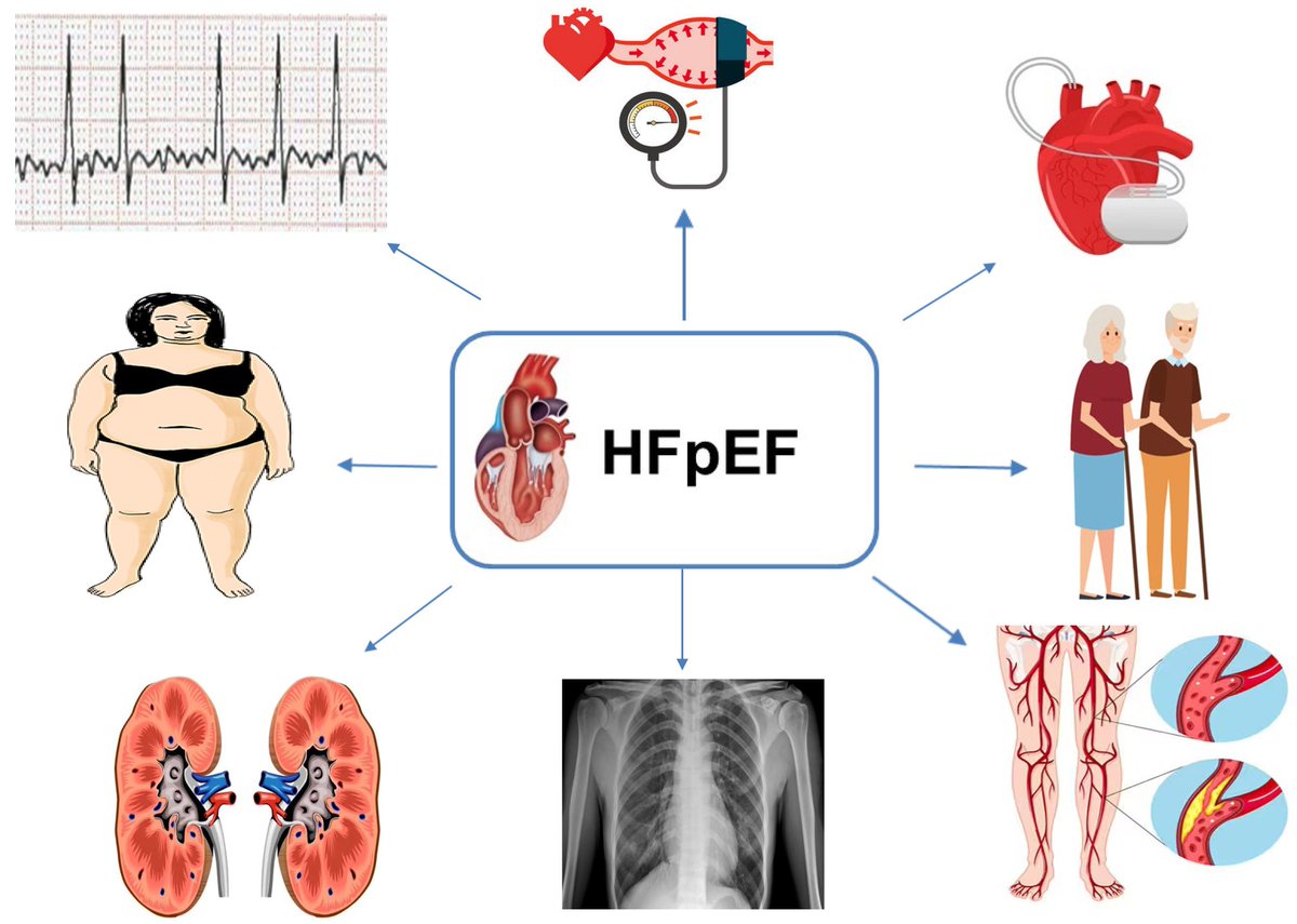 ZHeart11768530's tweet photo. 🔴Distinct Profiles and New Pharmacological Targets for HFpEF #2024Review #OpenAccess
🔹https://t.co/WQcBBtQril
#EKG #Multifocal #ECG #Cardiology #MAT #Atrial #Tachycardia #Diagnosis #comparison #electrocardiogram #Arrhythmias #ekg #clinical #ekg #diagnosis #tachycardia https://t.co/NKgfXaArqX