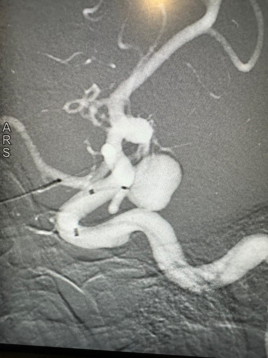 GalaxyThera's tweet photo. Another great success for Galaxy!  A remarkable large sidewall aneurysm treated successfully with SEAL device under compassionate use. We thank Dr. Brian Jankowitz and his team at JFK University Medical Center NY for being a great advocate for Galaxy SEAL. https://t.co/0ohgViQOKi