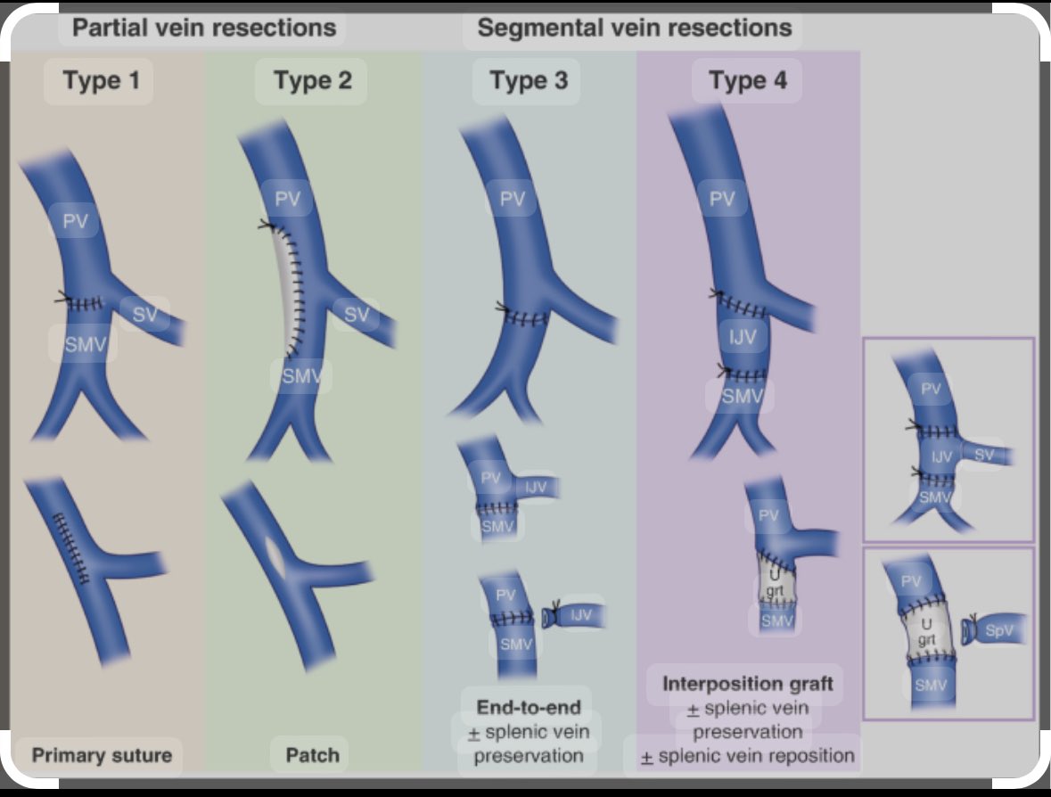 Syed A. Ahmad (@syedaahmad5) on Twitter photo Classification for SMV/ Portal vein reconstruction. <a href="/SAGES_Updates/">SAGES is in Tampa in 2026!</a> <a href="/juliomayol/">Julio Mayol</a> <a href="/TomVargheseJr/">Tom Varghese Jr. MD, MS, MBA, FACS, MAMSE 🇺🇸</a> Classification for SMV/ Portal vein reconstruction. <a href="/SAGES_Updates/">SAGES is in Tampa in 2026!</a> <a href="/juliomayol/">Julio Mayol</a> <a href="/TomVargheseJr/">Tom Varghese Jr. MD, MS, MBA, FACS, MAMSE 🇺🇸</a>