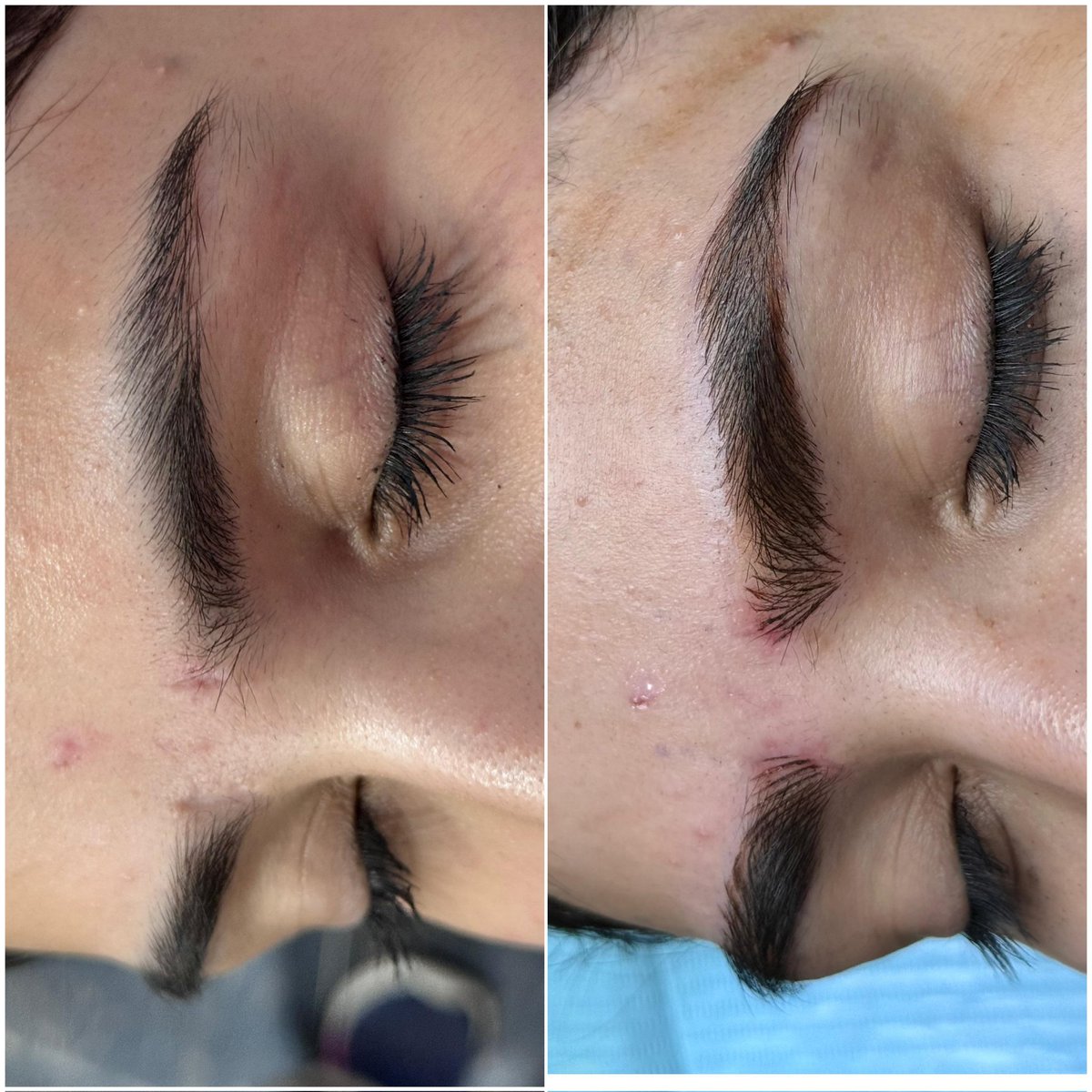 Es0t3ric's tweet photo. Microblading service focused on scar camouflage with customized brow design۔ #MicrobladingMagic #ScarCamouflage #CustomBrows https://t.co/7LaoEruo1I