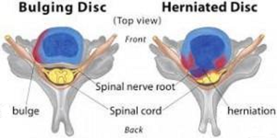 drdozellodc's tweet photo. Lumbar Disc Herniation and Disc Bulge
Dr Donald A Ozello DC of Championship Chiropractic
Newsletter - August 2024
#vegas #chiropractor #chiropractic #lumbardischerniation #discherniation #lumbardiscbulge #discbulge #lumbarspine #lowbackpain #lowerbackpain https://t.co/998GAB4AiB https://t.co/Cvq8ShEtfy
