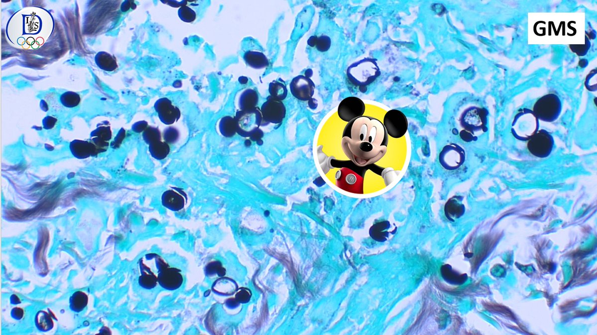 Int Soc Dermpath (@intsocdermpath) on Twitter photo #ISDP #OlympicGames
Spot diagnosis
Case 14 - <a href="/JCandidoXavier/">Jose Candido</a>
PARACOCCIDIOIDOMYCOSIS
•Dimorphic fungi (mycelial in the environment and yeast in the host)
•Granulomatous reaction pattern
•Round yeast with single or multiple buds with narrow necks.
#derm #path #pathology #ISDP #OlympicGames
Spot diagnosis
Case 14 - <a href="/JCandidoXavier/">Jose Candido</a>
PARACOCCIDIOIDOMYCOSIS
•Dimorphic fungi (mycelial in the environment and yeast in the host)
•Granulomatous reaction pattern
•Round yeast with single or multiple buds with narrow necks.
#derm #path #pathology