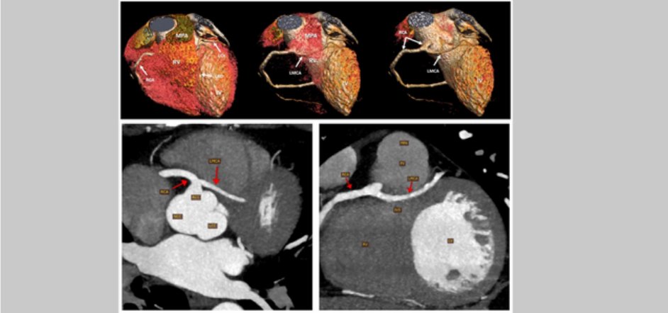 echo_stepbystep's tweet image. #ImageoftheWeek This #quiz was submitted by Mahmoud Naseem Shaaban from the Aswan Heart Centre (Magdi Yacoub Foundation), Aswan, 🇪🇬
What is the course of this anomalous (LMCA) originating from the right coronary artery (RCA)?
☑️shorturl.at/6f8Dr
@EACVIPresident
