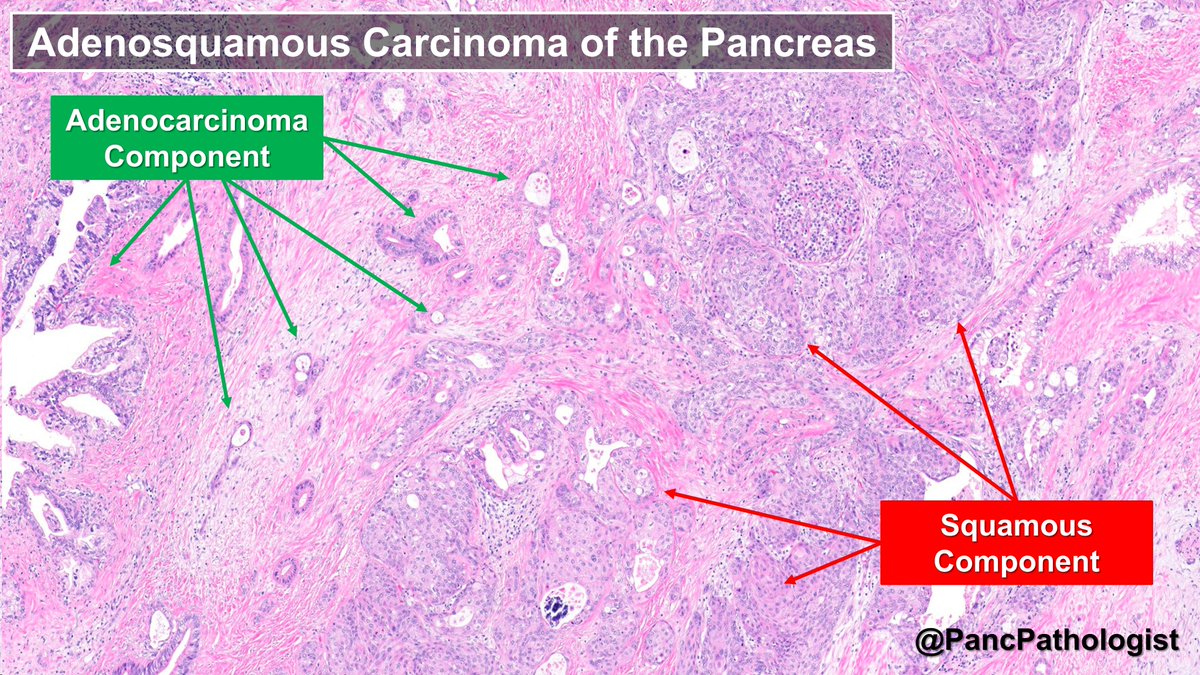 PancPathologist's tweet image. Pancreatic Adenosquamous Carcinoma (#PASC) is an aggressive variant of pancreatic ductal adenocarcinoma (#PDAC), characterized by glandular and squamous differentiation (at least 30% of the neoplasm) & can harbor BRCA/PALB2 mutation. #GIPath #Pathology #PancreaticCancer #Pancreas