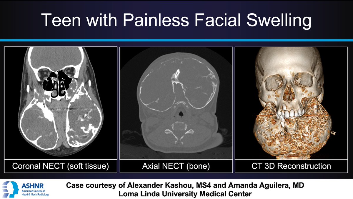 ASHNR (@ashnrsociety) on Twitter photo #ASHNRCOTW #264: Face Swelling. Thx
<a href="/alexkashou/">Alex Kashou</a> + <a href="/AAguilera_MD/">Amanda Aguilera, MD</a> 4 case! #ASHNR24
Answer w/ appropriate GIF only -- stay professional & don't spoil it!
<a href="/callyrobs/">Caroline Robson, MBChB</a> <a href="/DShatzkes/">Deborah Shatzkes</a> <a href="/CDP_Rad/">C Douglas Phillips ๐บ๐ธ</a> <a href="/rhwiggins/">Richard Wiggins</a> <a href="/nakoontz/">Nicholas Koontz</a> <a href="/KRileyMD/">Kalen Riley</a> <a href="/CMGlastonbury/">Christine M Glastonbury, MD</a> <a href="/cmtomblinson/">Courtney Tomblinson, MD</a> <a href="/tabby_kennedy/">Tabby A. Kennedy, MD</a>
<a href="/PhilipRChapman1/">Philip R. Chapman, MD</a> #ASHNRCOTW #264: Face Swelling. Thx
<a href="/alexkashou/">Alex Kashou</a> + <a href="/AAguilera_MD/">Amanda Aguilera, MD</a> 4 case! #ASHNR24
Answer w/ appropriate GIF only -- stay professional & don't spoil it!
<a href="/callyrobs/">Caroline Robson, MBChB</a> <a href="/DShatzkes/">Deborah Shatzkes</a> <a href="/CDP_Rad/">C Douglas Phillips ๐บ๐ธ</a> <a href="/rhwiggins/">Richard Wiggins</a> <a href="/nakoontz/">Nicholas Koontz</a> <a href="/KRileyMD/">Kalen Riley</a> <a href="/CMGlastonbury/">Christine M Glastonbury, MD</a> <a href="/cmtomblinson/">Courtney Tomblinson, MD</a> <a href="/tabby_kennedy/">Tabby A. Kennedy, MD</a>
<a href="/PhilipRChapman1/">Philip R. Chapman, MD</a>