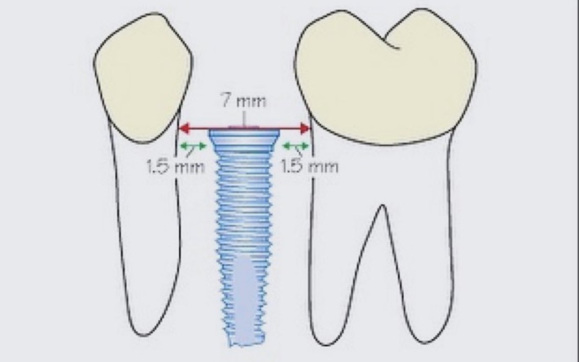 DiariesDent's tweet photo. Implants 📚

A 7 mm interdental distance is considered as a routine case, i.e. a standard implant can be placed without particular risk!.

For the smallest spaces (5-6 mm), one should consider the use of small diameter implants to avoid excessive proximal bone loss. 
For larger spaces, a wide implant may be used if a sufficient thickness of bone is available. 
For edentulous areas exceeding 14 mm, two implants are required, to avoid horizontal cantilever.

Interdental Distance: Multiple Teeth 
Replacement:
The number and positions of implants are defined according to the prosthetic planning, and with respect to interimplant distances. 

A minimum of 7 mm is required between the centers of two standard implants.