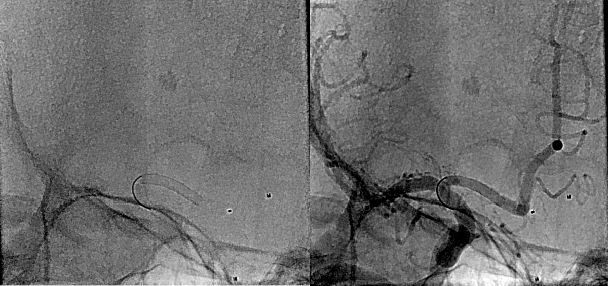 NeuroangioA tweet media