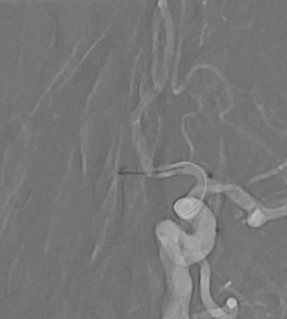 NeuroangioA tweet media