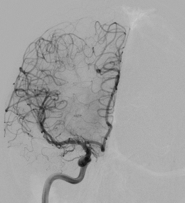 NeuroangioA tweet media