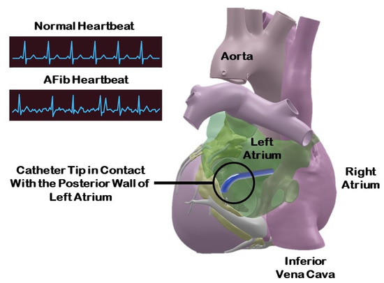 Actuators_MDPI's tweet photo. #Article 
📜 Cosserat Rod-Based Dynamic Modeling of a Hybrid-Actuated Soft Robot for Robot-Assisted Cardiac Ablation
by Majid Roshanfar, et al.
https://t.co/6e6cT54ste 
@Concordia 
@mcgillu 
@MDPIOpenAccess 

#Cosseratrod #softrobot #dynamicmodeling #hybridactuation https://t.co/NweObUaLZs