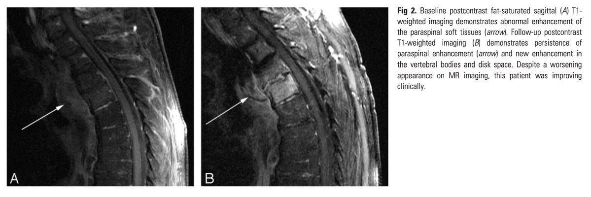 TakaMatsuo_ID's tweet photo. 【Follow-up MRI in vertebral osteomyelitis】Am J Neuroradiol 2007 #OrthoID #Keyarticle

Q: Do we need f/u MRI?

A: Not recommended, incorrelation w/ clinical features

Worse compared w/ baseline
👉Vertebral body/disk space enhancement
👉bone marrow edema

https://t.co/YE7AIZ59LR https://t.co/T3Sa9T18ZS