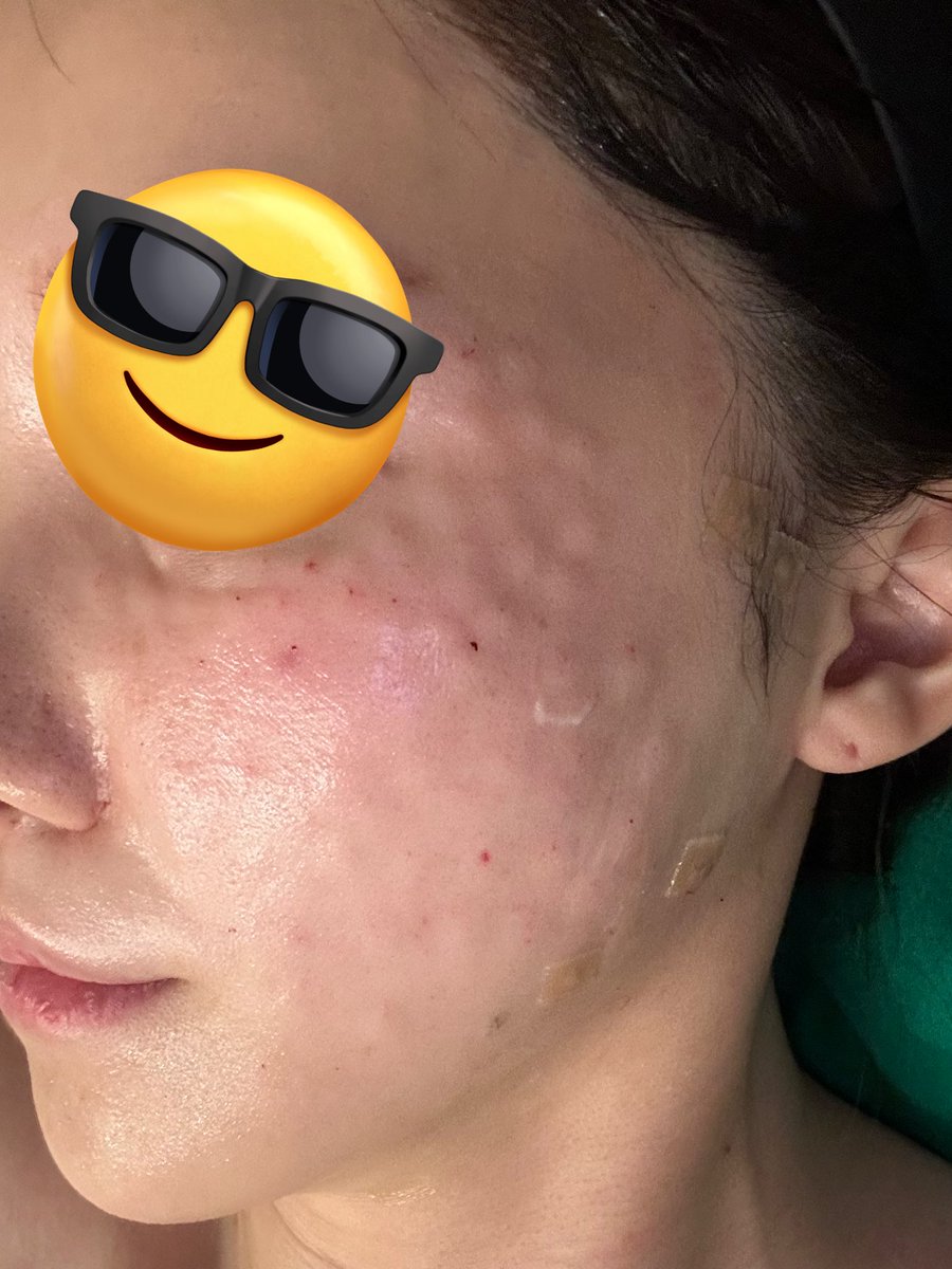 geeesschann's tweet photo. フォルテクリニック！肌の精密検査みたいな機械がめっちゃ凄かった😳それを元にカウセで施術内容決めたんだけど親身に聞いてくれるし要らないものもハッキリと言ってくれて好印象🥰何より安い
オープンばかりでバタバタしてるのが気になったけど対応も良かった。 https://t.co/vYfV7ti8si