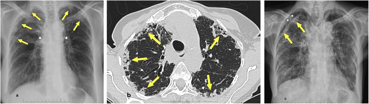 SERAM - Sociedad Española de Radiología Médica (@seram_rx) on Twitter photo 📙 Este artículo de la <a href="/RevistaRADIOLO2/">@RevistaRADIOLOGIA</a> describe las características clínicas y radiopatológicas de la fibroelastosis pulmonar primaria
Accede aquí 🔗 buff.ly/4duf5mv
Link to the english version 🔗 buff.ly/3LOlzRA 📙 Este artículo de la <a href="/RevistaRADIOLO2/">@RevistaRADIOLOGIA</a> describe las características clínicas y radiopatológicas de la fibroelastosis pulmonar primaria
Accede aquí 🔗 buff.ly/4duf5mv
Link to the english version 🔗 buff.ly/3LOlzRA
