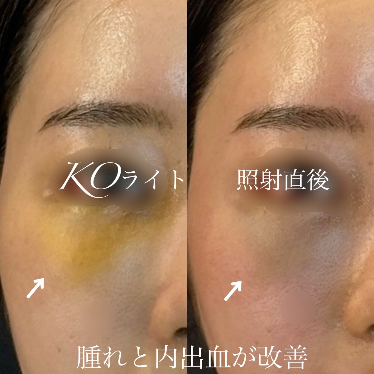 ダウンタイムを減らしたい。 そんな時はぜひKOライトを。 ①抗炎症効果