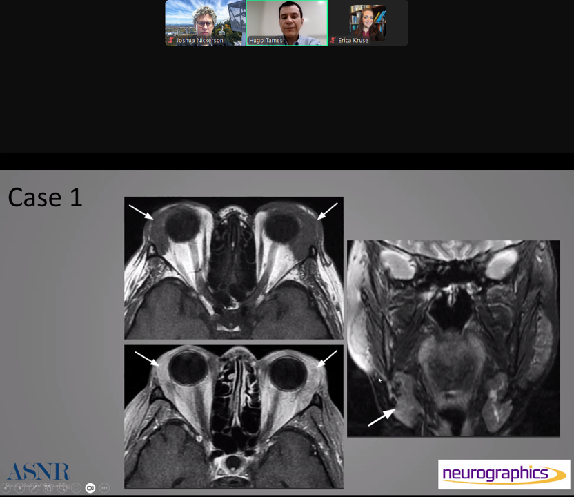 neurokinghippo's tweet photo. And we are live with today's @ASNRographics webinar from @TheASNR. Featured author @HugoTames of Sao Paulo Brazil is out presenter reviewing IgG4 disease of the H&amp;N. @ASHNRSociety #radres #neurorad https://t.co/4FsdmS7aBN