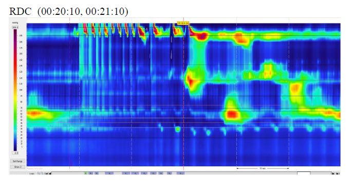 A Clinical Challenge for Our Gastro &amp; Gastro Fellow Colleagues: Using these esophageal manometry images alone, what would your projected Chicago Classification version 4.0 esophageal motility diagnosis be after the full study was interpreted?  (Results shared with patient