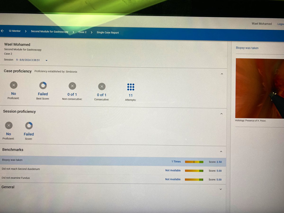 Any #GITwitter first year fellows who did the <a href="/Simbionix/">Simbionix</a> endoscopy sim modules, would be able to tell me how to tackle case 2 of gastroscope second module?

Failed me ~ 11 times or so, despite taking random biopsies from the duodenal ulcer, bulb, second part, &amp; gastric biopsies!